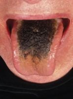 black-hairy-tongue.jpg