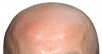 bald_head.jpg