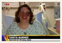 tanya-barnes-pit-bull-attack.jpg