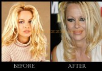 pamela-anderson-before-after-plastic-surgery.jpg