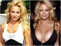 Pam-Anderson-plastic-surgery-1024.jpg