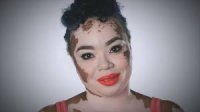 Vitiligo1.jpg