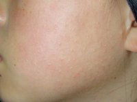 keratosispilaris(020511).jpg